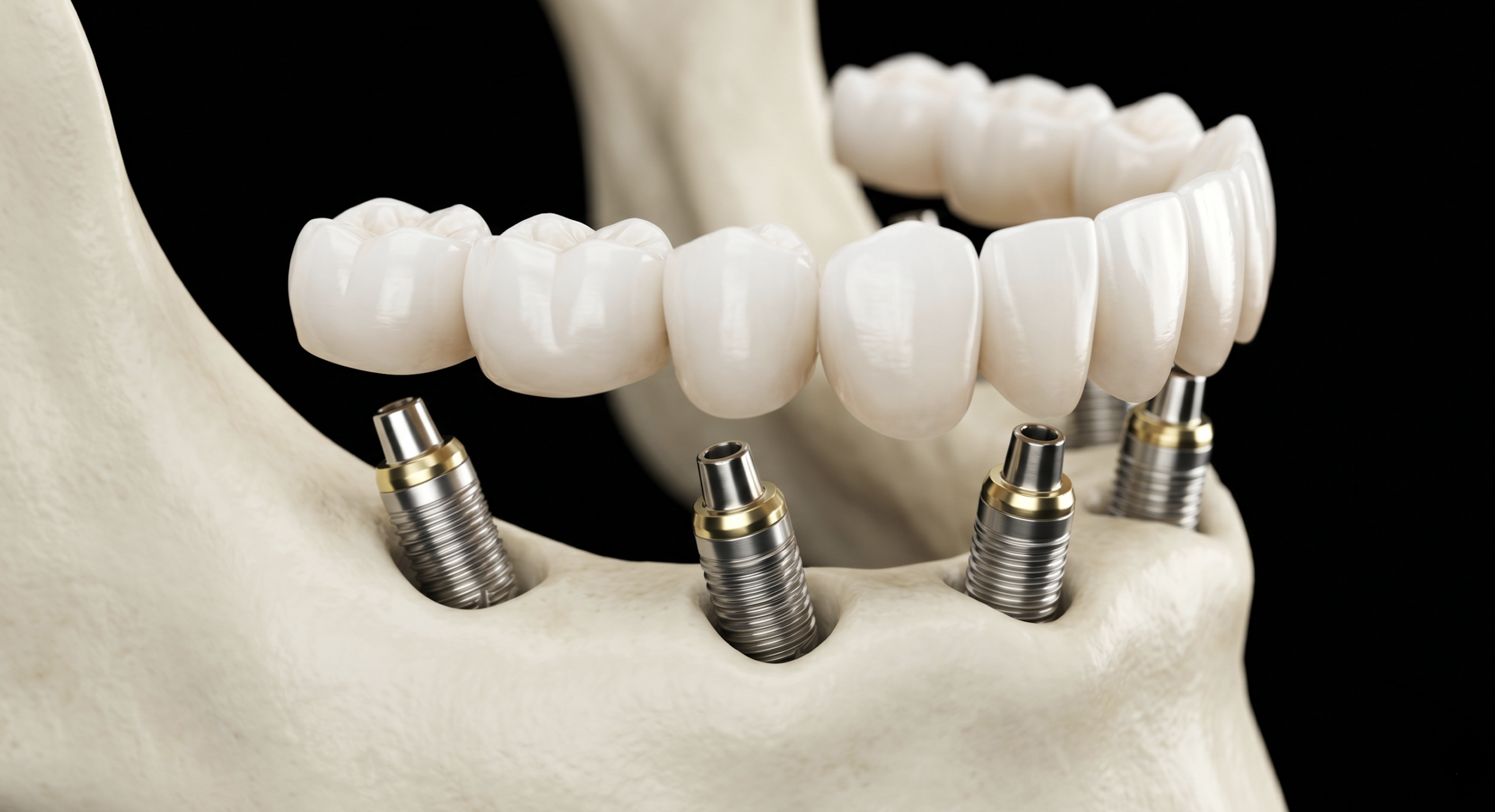 Full-Arch Restoration All-on-4 Dr Laith Azzouni Coral Springs Pembroke Pines